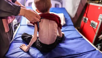 استشهاد 66 طفلاً في قطاع غزة نتيجة سوء التغذية