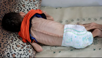 ارتفاع شهداء سوء التغذية والمجاعة في غزة إلى 155