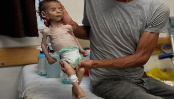 12 ألف طفل دون الخامسة يعانون من سوء التغذية الحاد بقطاع غزة