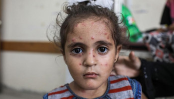 تفشي جدري الماء في مخيمات غزة وسط ظروف صحية صعبة ونقص في مقومات الوقاية
