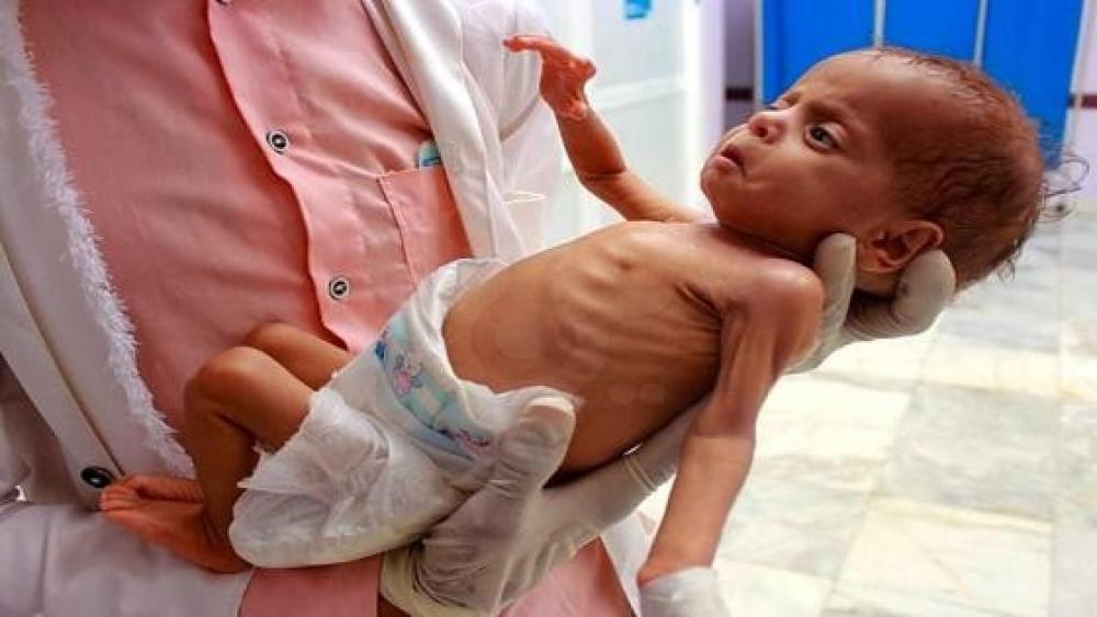 أطباء بلا حدود تحذر من ارتفاع غير مسبوق لمعدلات سوء التغذية بغزة
