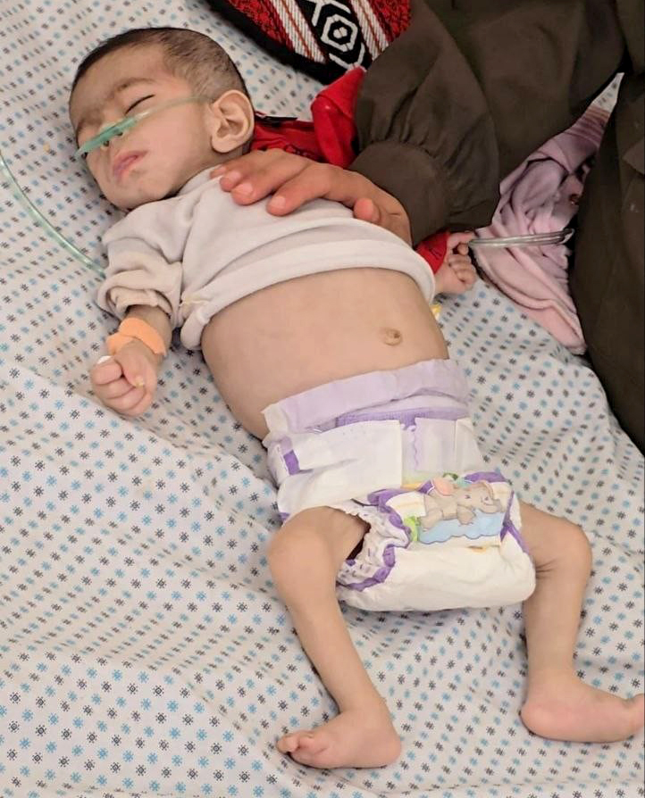 وفاة رضيع فلسطيني نتيجة سوء التغذية والمجاعة في قطاع غزة