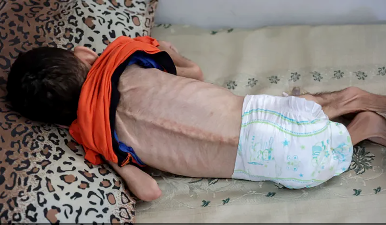 ارتفاع شهداء سوء التغذية والمجاعة في غزة إلى 155