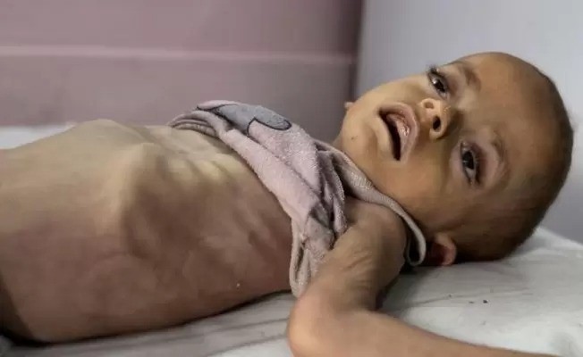 استشهاد طفل فلسطيني نتيجة سوء التغذية في خانيونس
