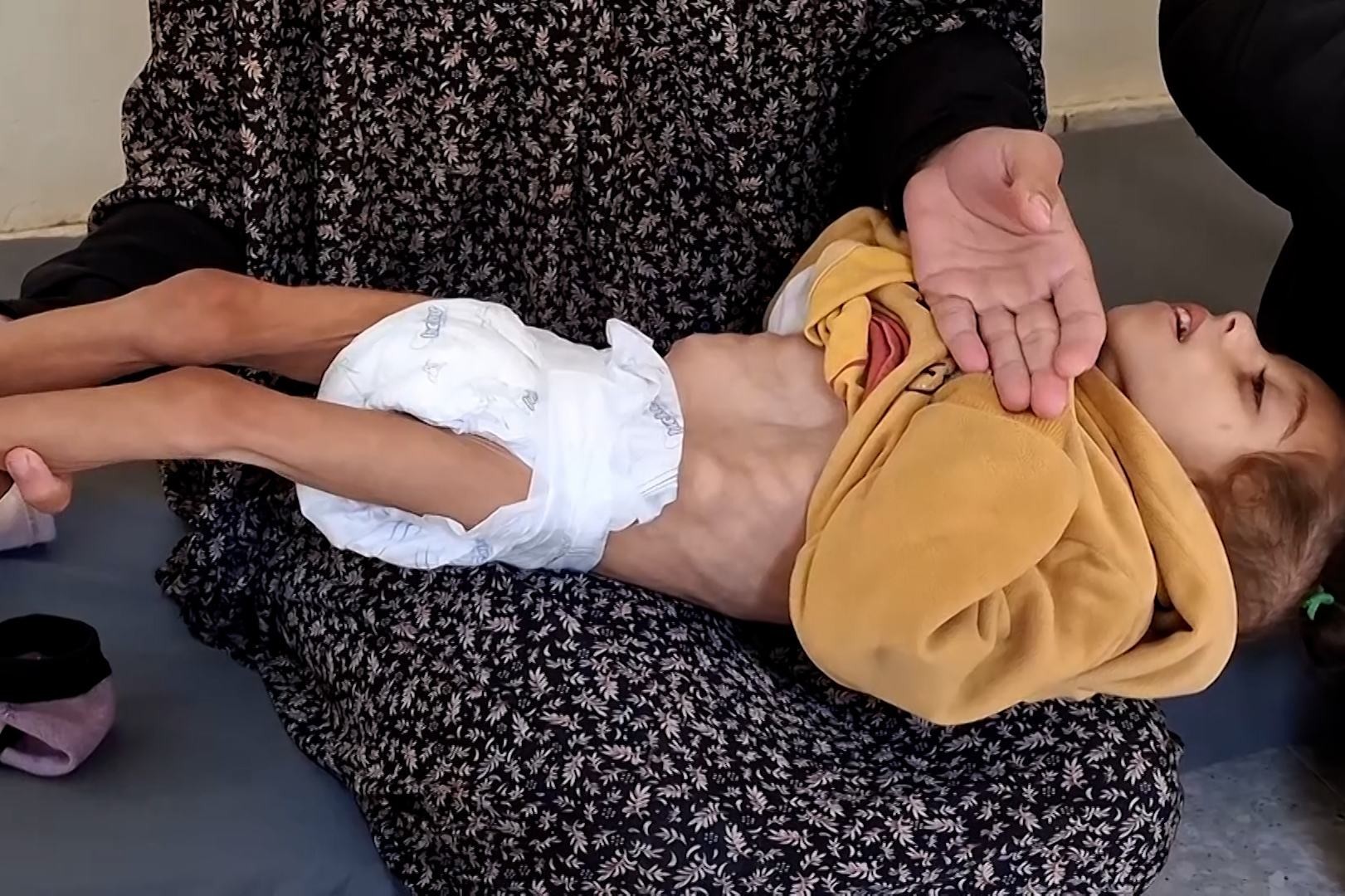 466 شهيداً بينهم 157 طفلًا جراء سوء التغذية والتجويع بغزة